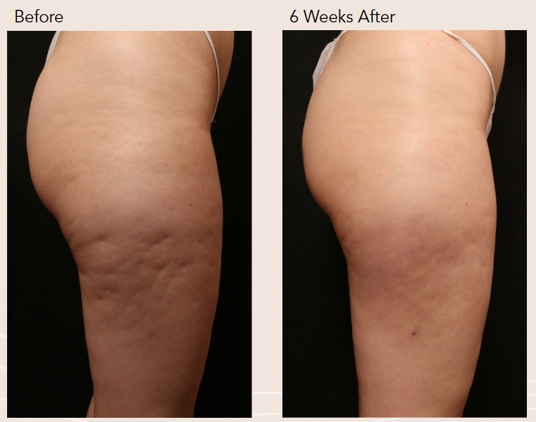 Aveli cellulite treatment
