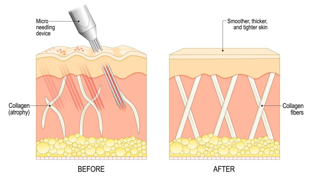 Microneedling Diagram