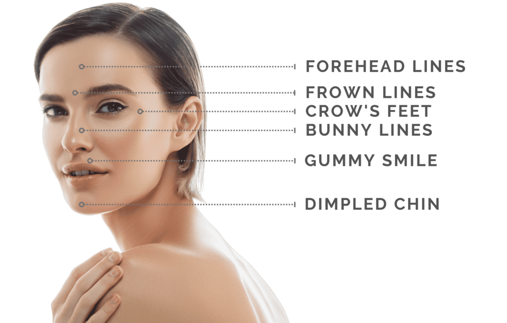 Botox Treatment Areas