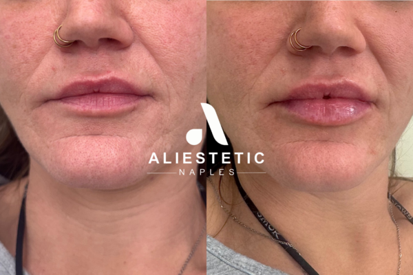 Juvederm Ultra XC, 1/2 syringe