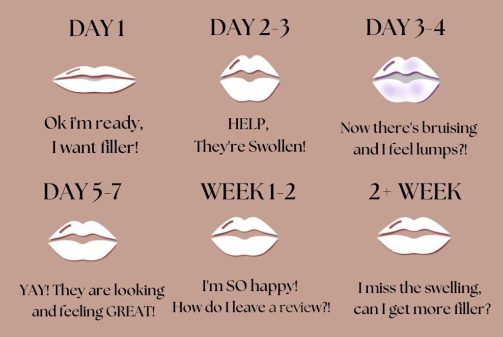 Lip Filler Experience