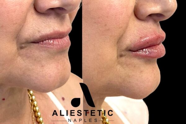 Juvederm Ultra XC, 1 syringe