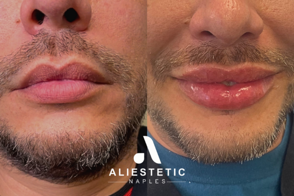 Juvederm Ultra Plus, 1 syringe + RHA 3, 1 syringe