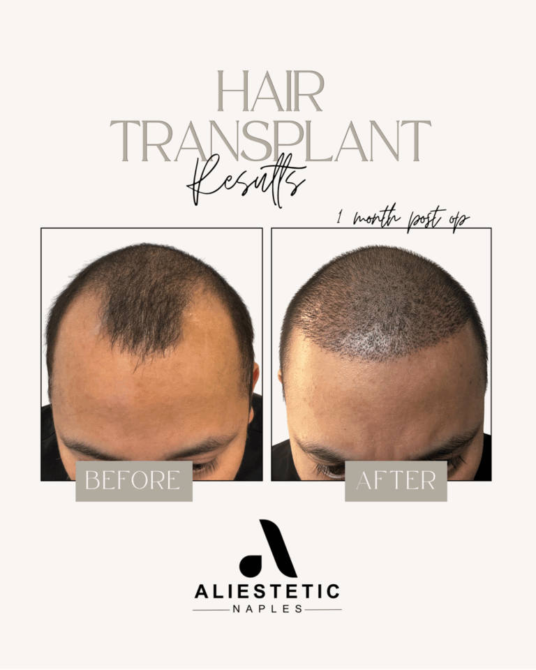 FUE Hair Transplant: 4 Weeks Post Op