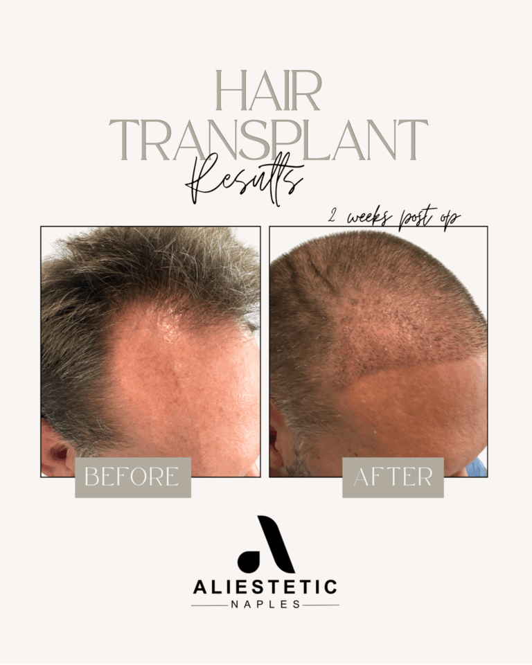FUE Hair Transplant: 2 Weeks Post Op