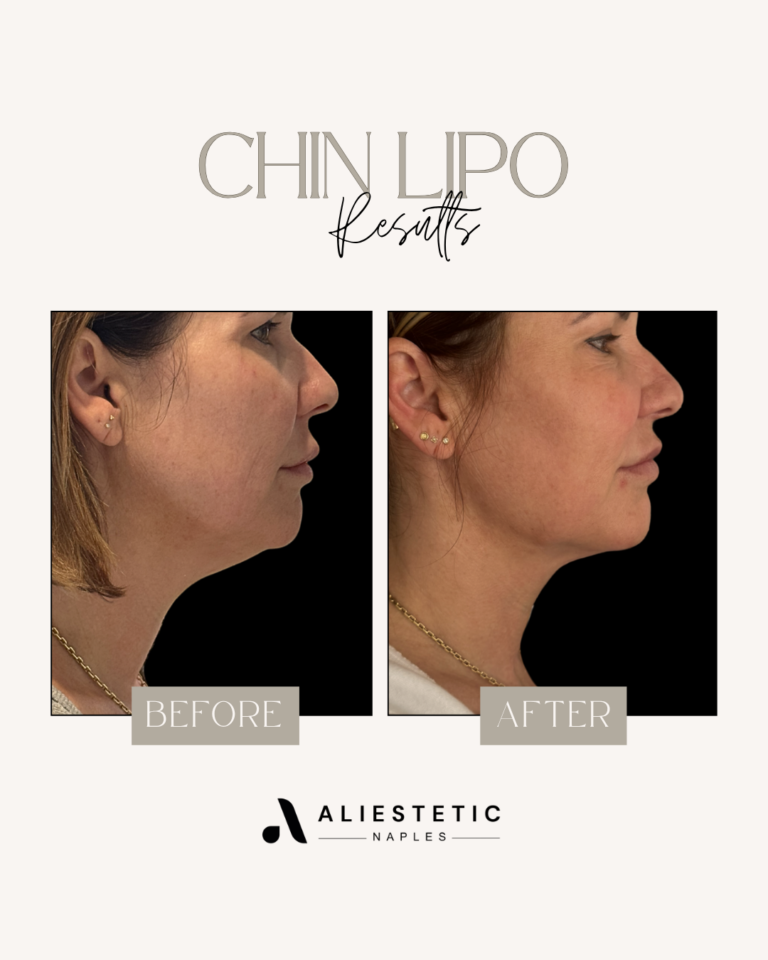 Chin lipo1
