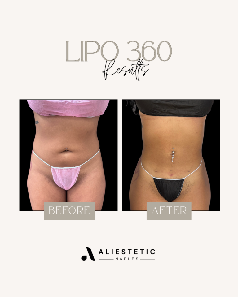 Lipo 360-2